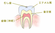 C0:初期虫歯