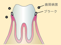 初期歯周病(歯肉炎)